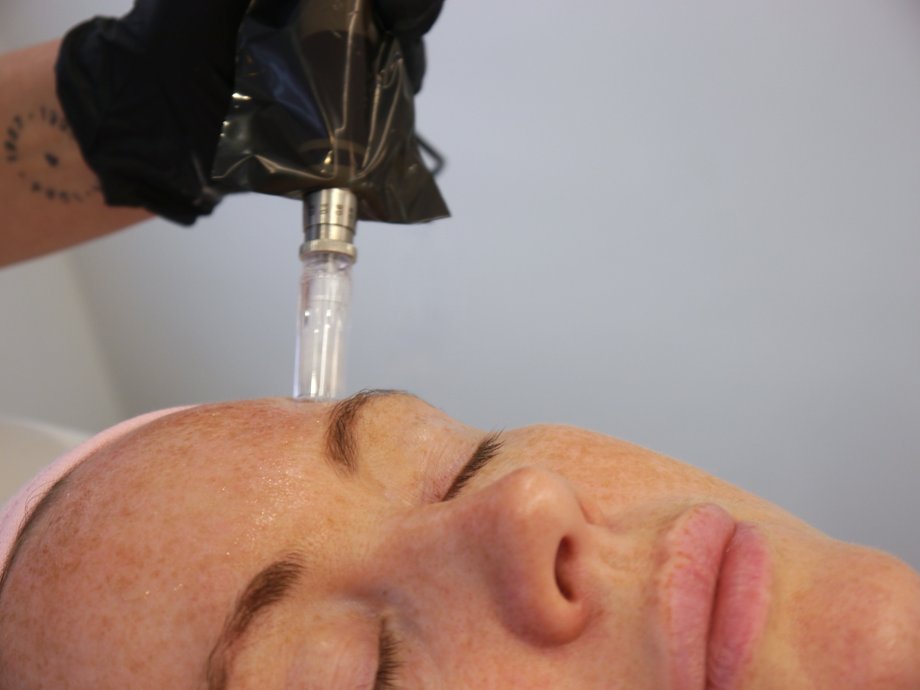 Skin booster treatment